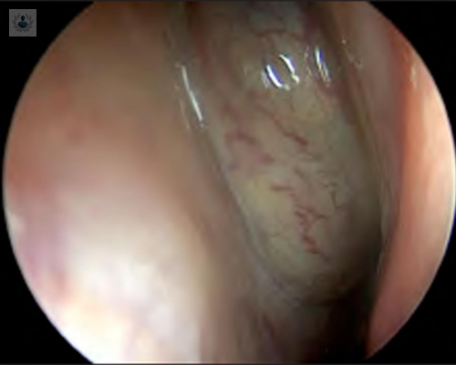 tumores-tambien-aparecen-en-la-nariz imagen de artículo