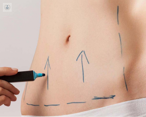 abdomen-de-10-es-posible-con-una-abdominoplastia imagen de artículo