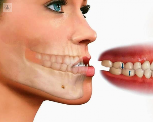 Prognatismo Mandibular: una deformidad dentofacial tratable quirúrgicamente