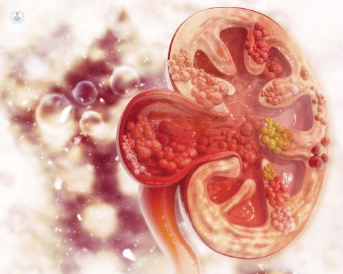 Piedras en el riñón: un padecimiento que se puede minimizar con el consumo de agua