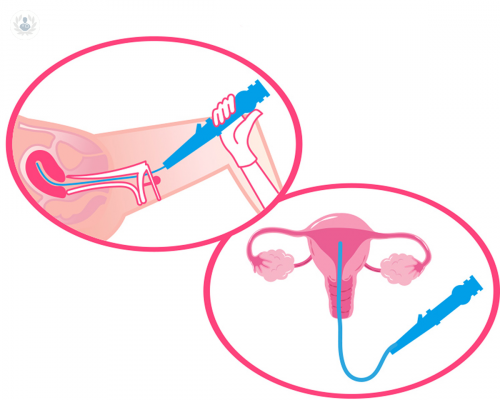 histeroscopia-un-procedimiento-seguro-rapido-y-minimamente-invasivo imagen de artículo
