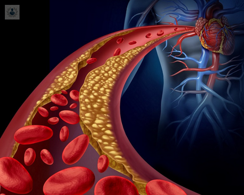 dislipidemia-importancia-atenderse-rapido imagen de artículo