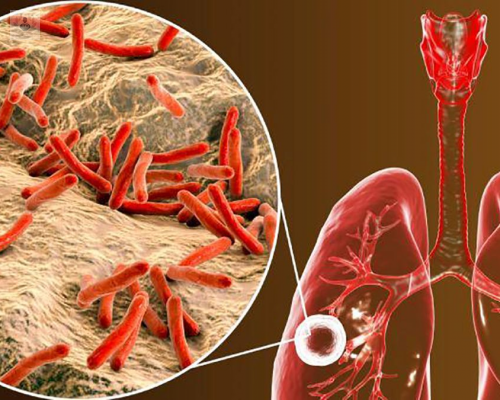 Tuberculosis y su estrecha relación con el Coronavirus