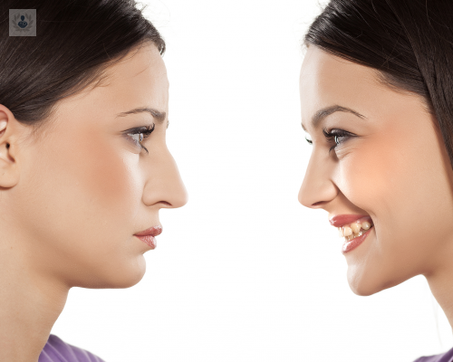 rinoplastia-estetica-o-funcional-conoce-el-beneficio-de-ambas imagen de artículo