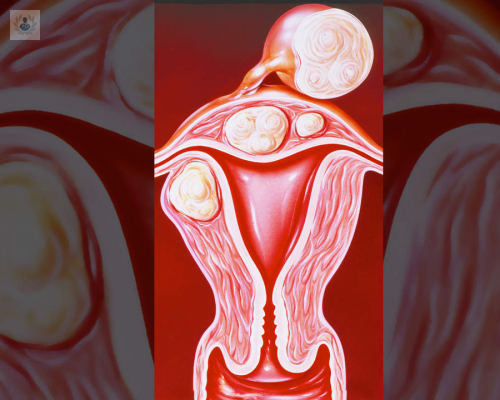 que-son-los-miomas-uterinos imagen de artículo