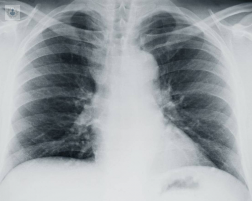 COVID-19 VS Daño Pulmonar