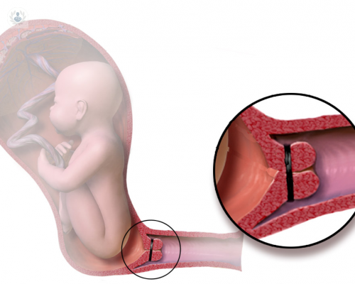 que-es-la-incompetencia-istmico-cervical imagen de artículo