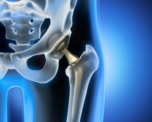 las-tecnicas-mas-actuales-para-la-cirugia-de-cadera-cual-es-la-mejor imagen de artículo