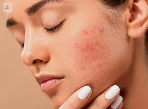 Causas del acné: Conoce todos los detalles