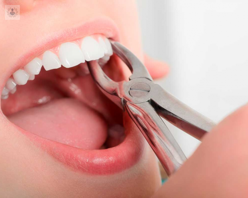 extraccion-dental-cuales-beneficios-desventajas imagen de artículo