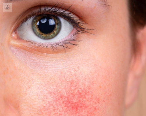que-es-la-rosacea-conoce-todos-sus-detalles imagen de artículo