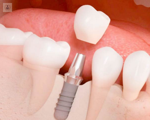 Implantes Dentales, ¿cómo se colocan?