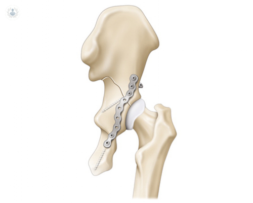 fractura-de-acetabulo-que-es imagen de artículo