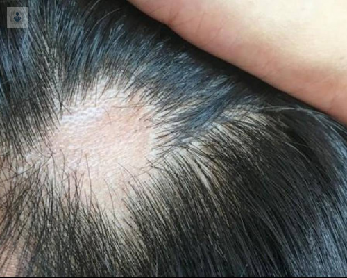 Alopecia: causas y tratamiento según su tipo