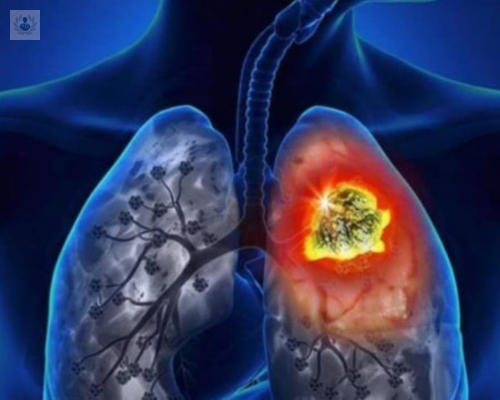 cancer-de-pulmon-diagnostico-causas-y-esperanza-de-vida imagen de artículo