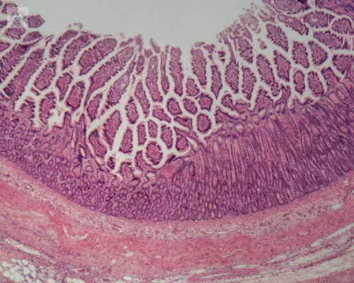 Lo que no sabías de la colitis microscópica