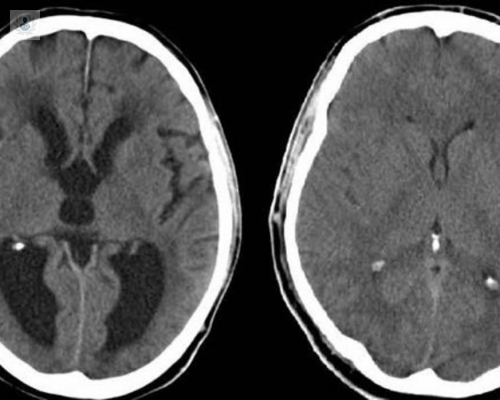 Hidrocefalia: más que líquido en el cerebro
