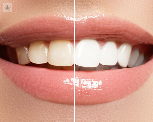 Blanqueamiento dental: ¿cómo se hace y cuánto tiempo dura el resultado?