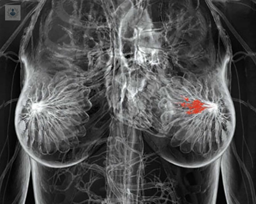 el-proceso-para-el-diagnostico-del-cancer-de-mama imagen de artículo