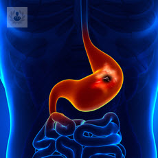 ulcera-gastroduodenal imagen de artículo