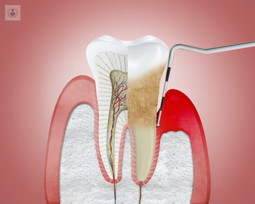 La enfermedad periodontal y su relación con las enfermedades crónico-degenerativas