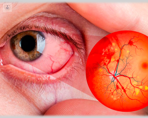 retinopatia-diabetica-prevencion-y-control-el-mejor-tratamiento imagen de artículo