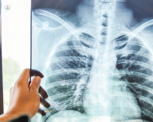 ¿Qué es la Tuberculosis? Contagio, síntomas y tratamiento