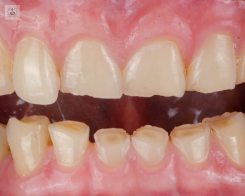 bruxismo-un-problema-dental-con-causas-psicologicas imagen de artículo