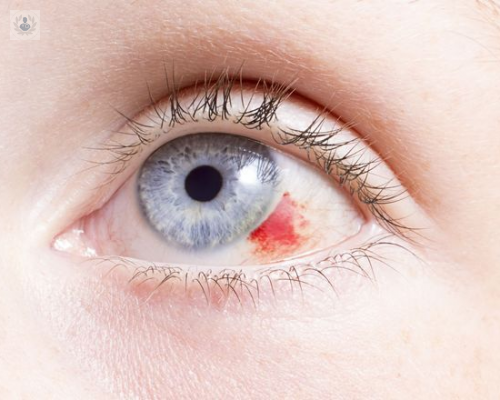 Trauma Ocular, una lesión que puede provocar la pérdida de la visión