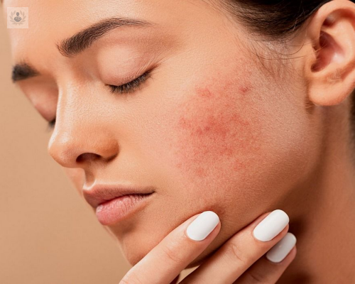 que-es-el-acne-que-lo-causa-y-cual-es-su-tratamiento imagen de artículo