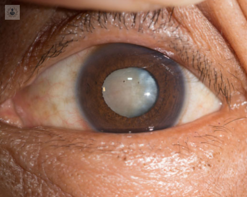 cataratas-causas-sintomas-y-tratamiento imagen de artículo