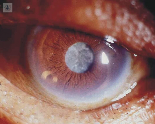 Cataratas: La primera causa de ceguera reversible