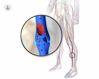 trombofilia-que-es-causas-y-tratamiento imagen de artículo