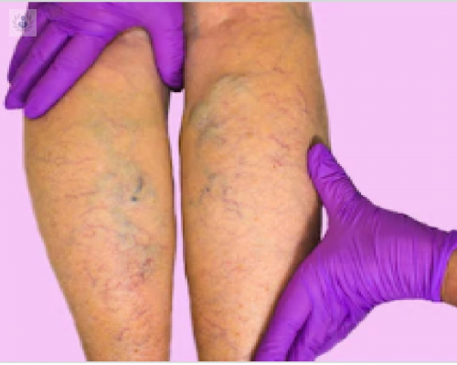 varices-cuales-son-los-tratamientos-invasivos-y-no-invasivos-que-se-utilizan-actualmente imagen de artículo