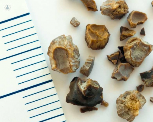 sabias-que-los-calculos-renales-podrian-ser-hereditarios-conoce-mas-sobre-ellos imagen de artículo