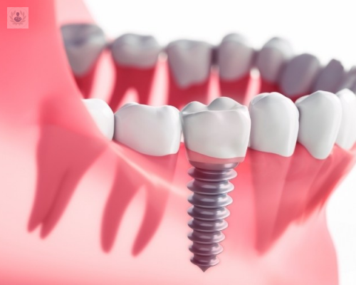 ¿Cuáles son las ventajas de los Implantes Dentales?