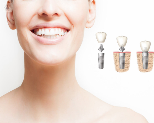 como-se-coloca-un-implante imagen de artículo