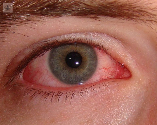 Alergia Ocular: recomendaciones para mitigar sus síntomas