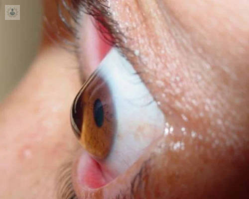 el-queratocono-es-hereditario imagen de artículo