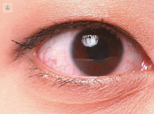 sindrome-de-ojo-seco-que-hacer-para-combatirlo imagen de artículo