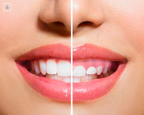 cuales-son-las-causas-de-la-sonrisa-gingival imagen de artículo