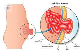 Hernia umbilical y hernia inguinal: síntomas y operación - Tani Salud
