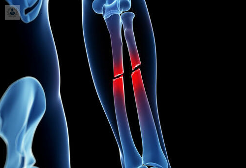 Todo lo que debe saber sobre las fracturas óseas