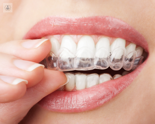 beneficios-de-la-ortodoncia-invisible imagen de artículo