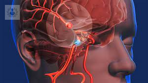 que-tratamientos-existen-para-el-aneurisma-cerebral imagen de artículo