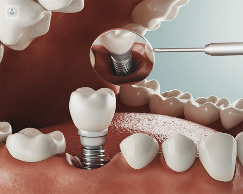 La importancia de la Implantología Oral