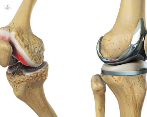 protesis-de-rodilla-beneficios-desventajas-y-riesgos imagen de artículo