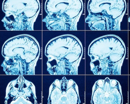 ¿Cómo se tratan los Tumores Cerebrales? 
