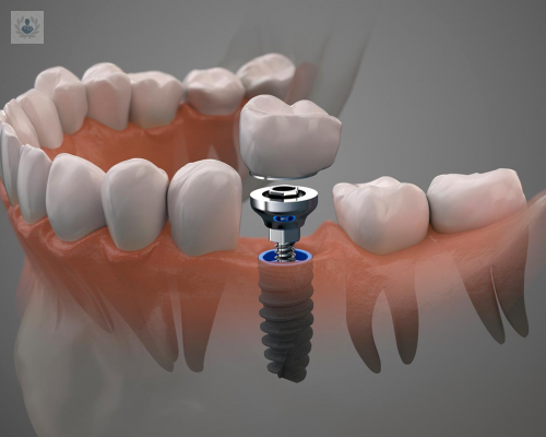 queson-los-implantes-dentales imagen de artículo