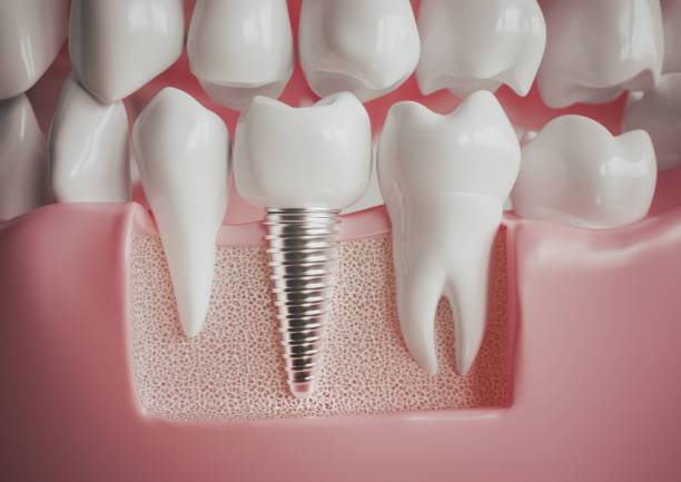 queson-los-implantes-dentales imagen de artículo